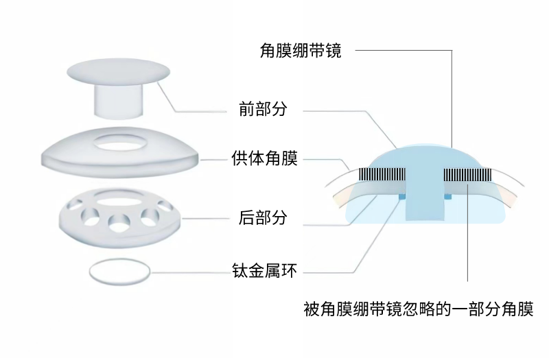 20220317672267.png 角膜绷带镜.png